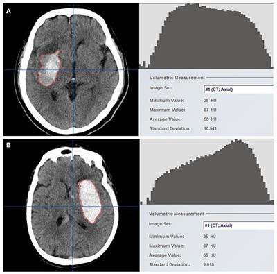 Quantitative hematoma heterogeneity associated with hematoma growth in patients with early intracerebral hemorrhage